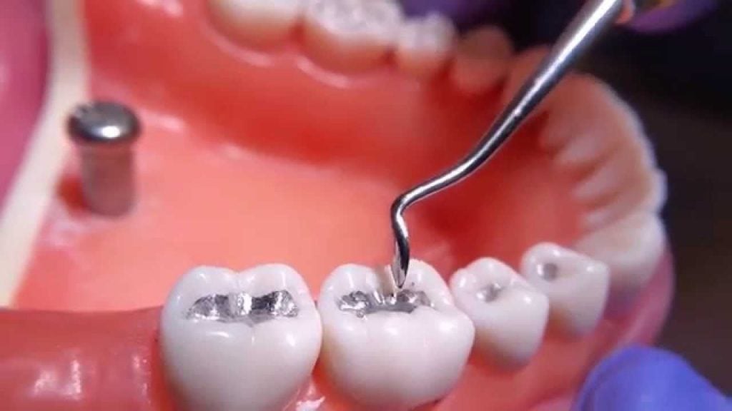 تاریخچۀ دندانپزشکی Gold Teeth Lose Luster as More Turn to Teeth Whitening, Ceramics